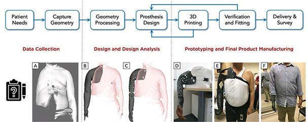 Low cost customised prosthesis using 3D printing